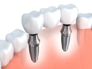 Dental Implants Bremerton